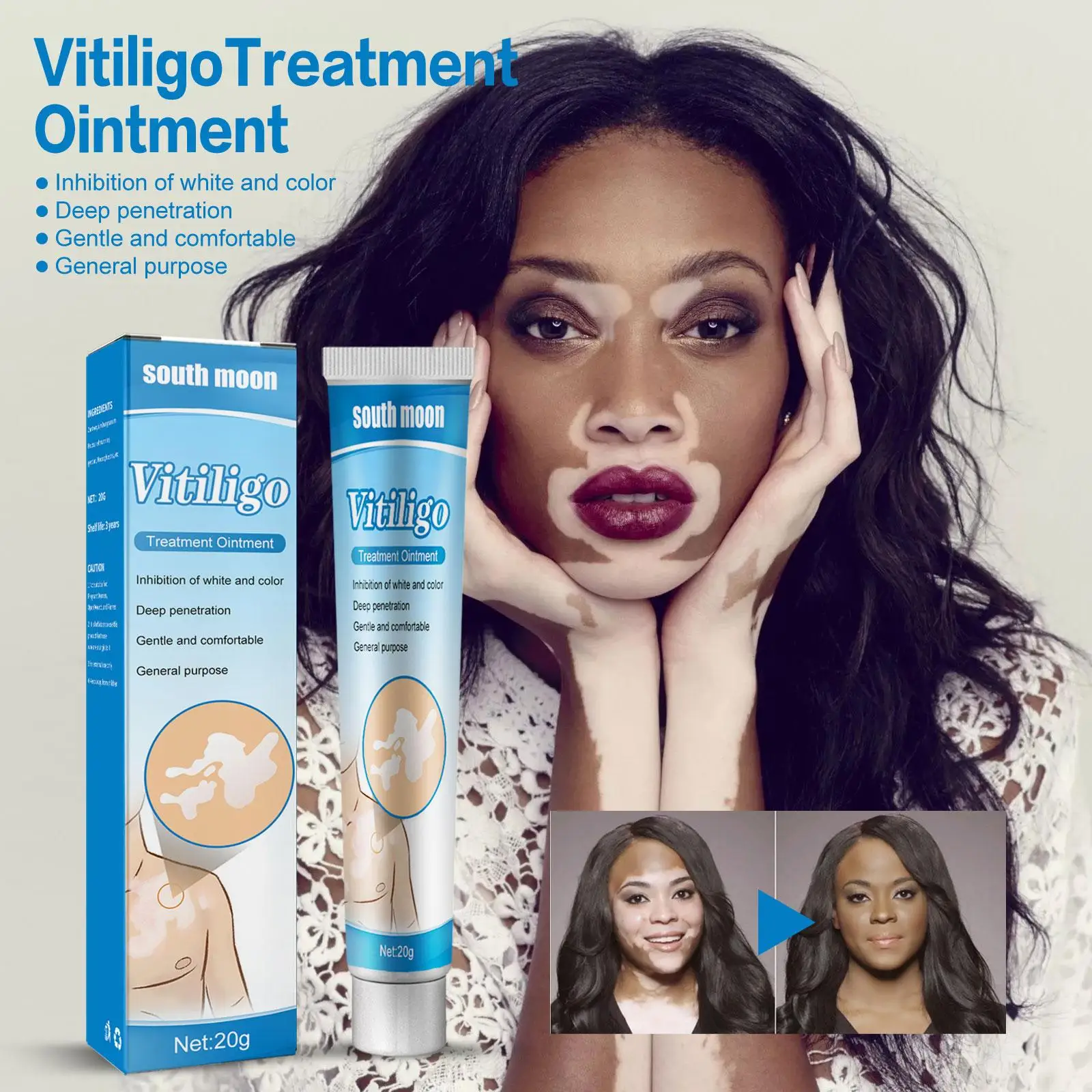 20g Tedavisi Nemlendirici Krem Beyaz Nokta Hastalığı Vitiligo Balsamı Onarım Merhem Tedavisi Rahatlatmak Cilt Kremi Vücut bakım kremi